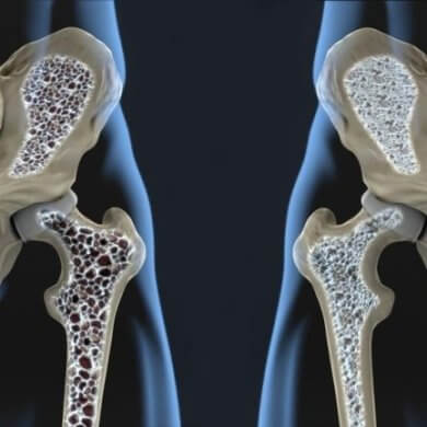 Understanding Osteoporosis Risks Treatment Home Care Services